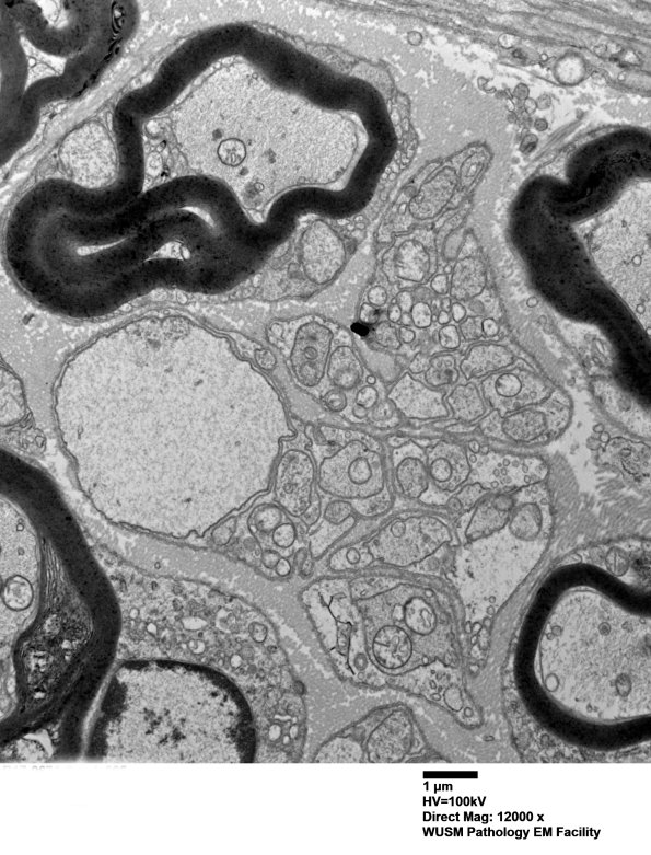 4B3 (Case 4) Sural_005 - Copy