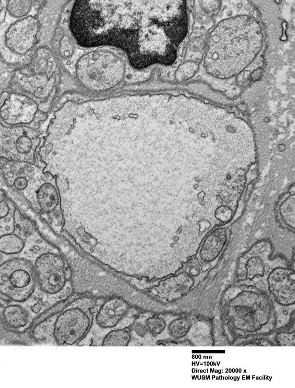 4B4 (Case 4) Sural_004 - Copy