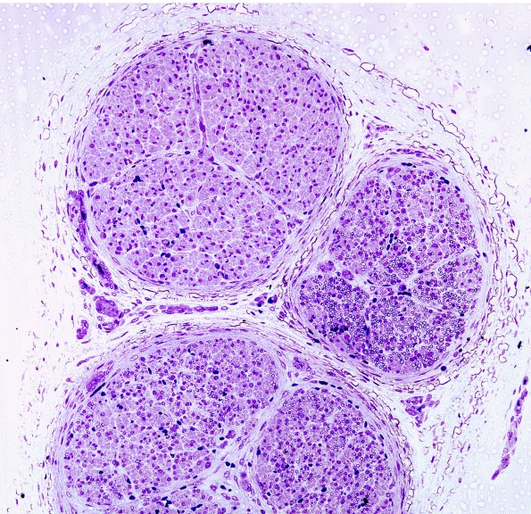 5A1 Sciatic nerve (Case 5) 21 wk fetus sciatic H&E 2
