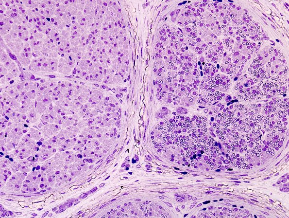 5A2  Sciatic nerve (Case 5) 21 wk fetus sciatic H&E 1