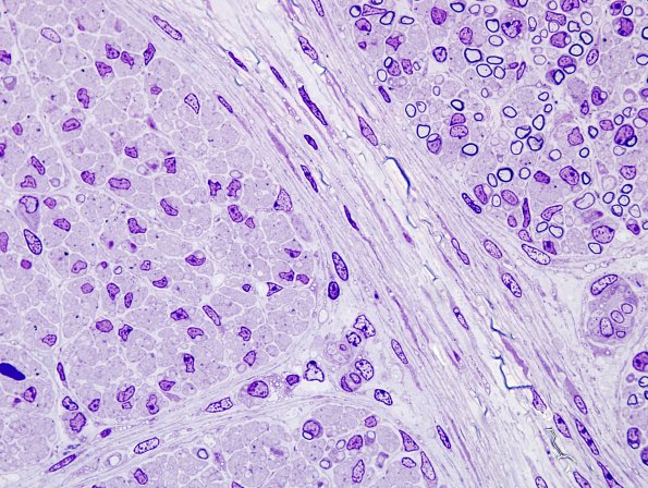 5A3  Sciatic nerve (Case 5) 21 wk fetus sciatic Plastic 1