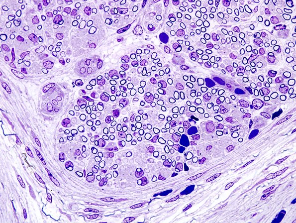 5A4  Sciatic nerve (Case 5) 21 wk fetus sciatic Plastic 2