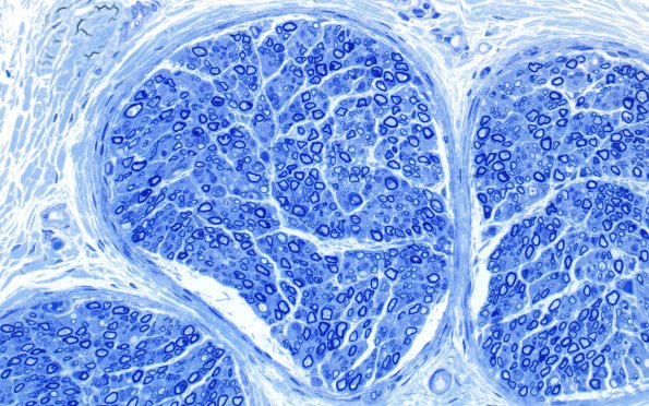 6A1 Infant, age 5MO (Case 6) Plastic 40X 1