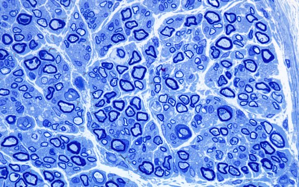 6A2 Infant, age 5MO Sciatic (Case 6) 21