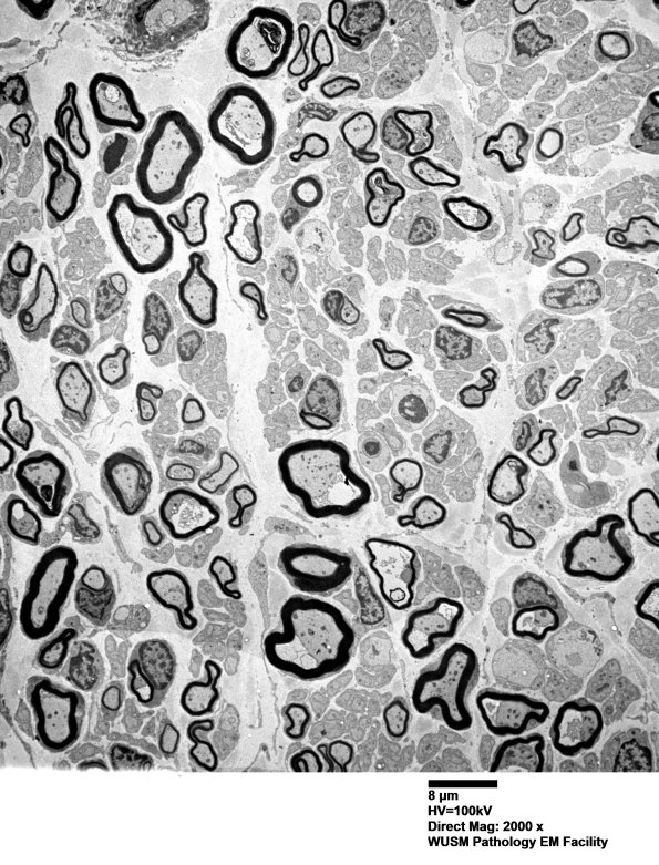 6B1 (Case 6) Sural_003 - Copy
