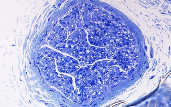 7A1 Infant, (Case 7) Plastic 60X 1