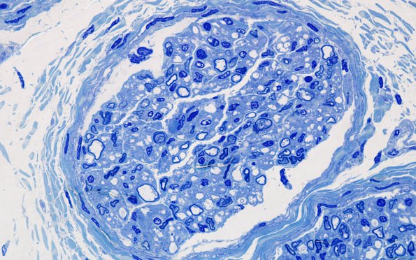 7A2 Infant, (Case 7) Plastic 100X 3