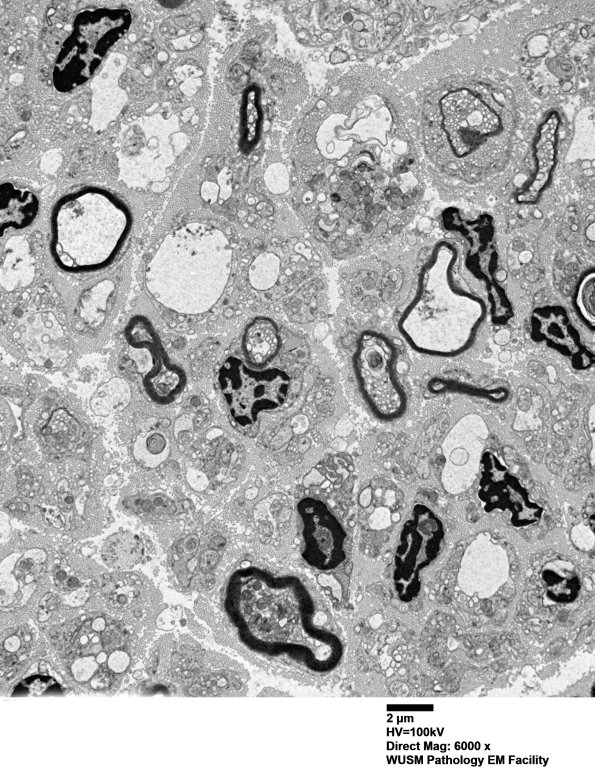 7B1 (Case 7) sural_005 - Copy