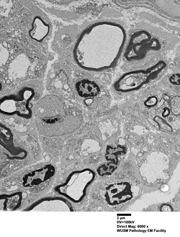 7B2 (Case 7) sural_006 - Copy