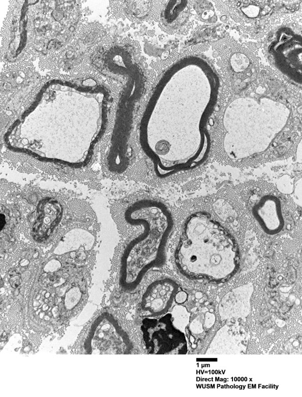7B3 (Case 7) sural_017 - Copy