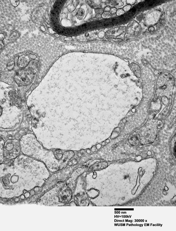 7B4 (Case 7) sural_010 - Copy