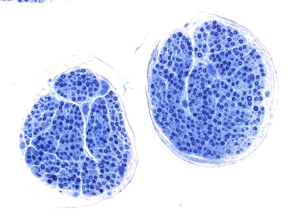 1A1 Nerve axons near nl AIN (Case 1) NP24-302) 10X