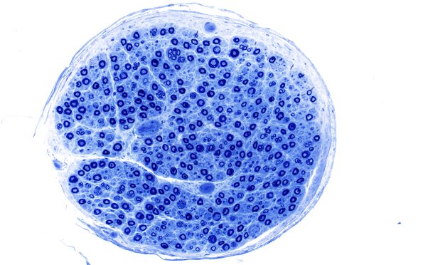 1A2 Nerve axons near nl AIN (Case 1) 20X 1