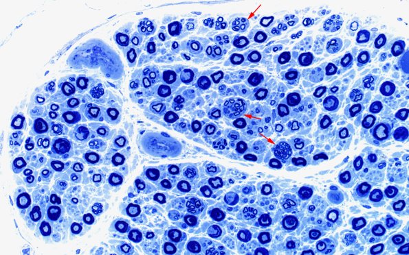 1A3 Nerve axons near nl AIN (Case 1) 40X 2 copy