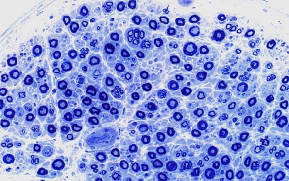 1A4 Nerve axons near nl AIN (Case 1) 40X 4