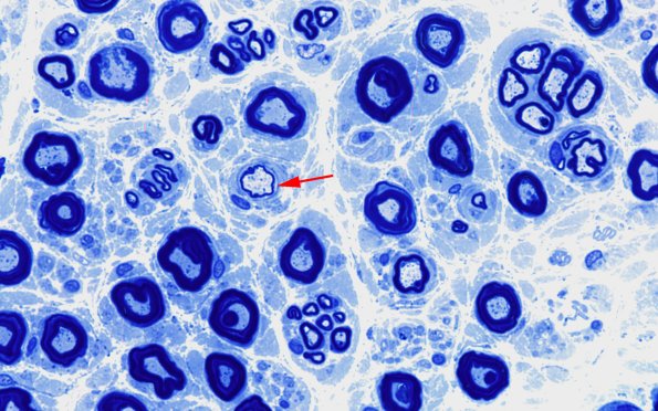 1A5 Nerve axons near nl AIN (Case 1) 100X 1 copy