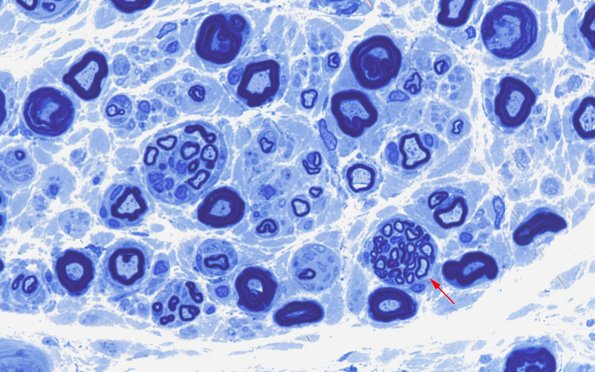 1A6 Nerve axons near nl AIN (Case 1)100X 7 copy