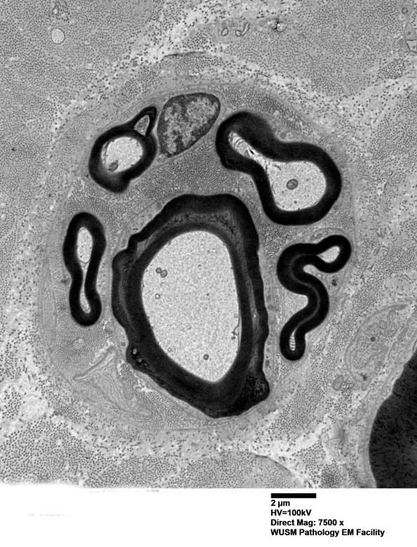 1B4 (Case 1) EM 023 - Copy