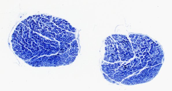 2A1 (Case 2) Plastic 10X