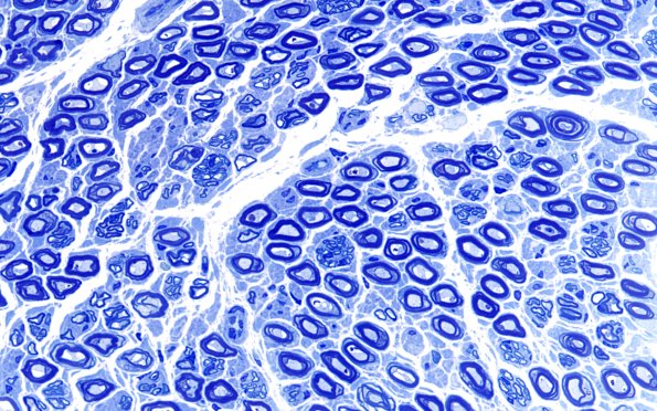 2A3 (Case 2) Plastic 60X 2