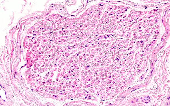 2C (Case 2) H&E 40X 1