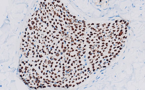 2D1 (Case 2) NF 40X 1