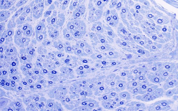 3A2 (Case 3) AIN AIN 40X