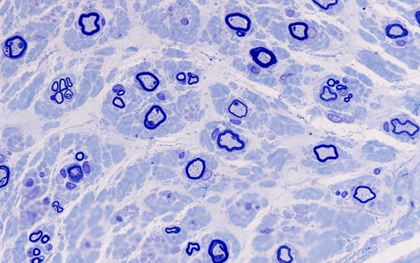 3A4 (Case 3) AIN 100X 1