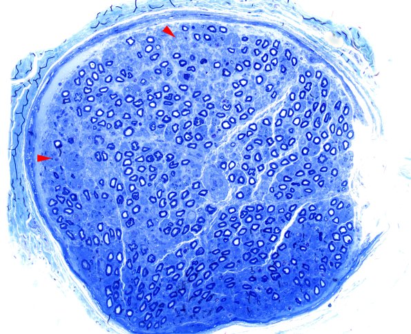 4A1 (Case 4) AIN Plastic 20X 2 copy