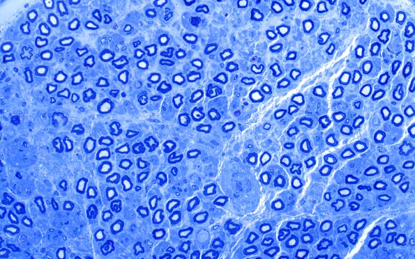 4A2 (Case 4) AIN Plastic 40X 2