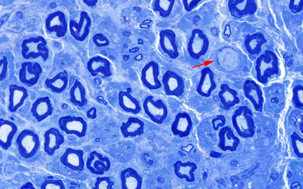 4A3 (Case 4) AIN Plastic 100X 1 copy