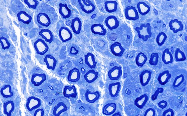 4A4 (Case 4) AIN Plastic 100X 2