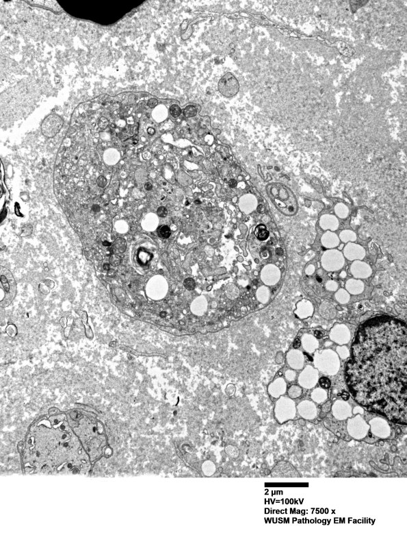 4B1 (Case 4) AIN EM 044 - Copy