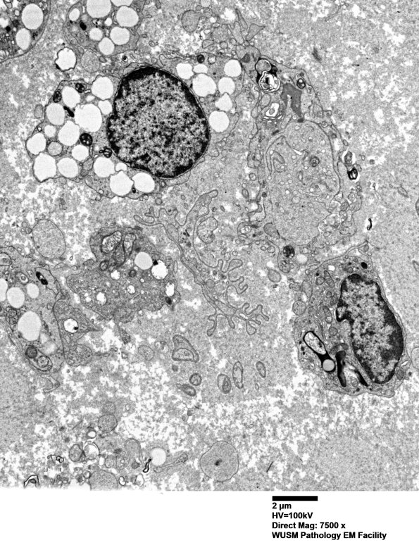 4B4 (Case 4) AIN EM 042 - Copy