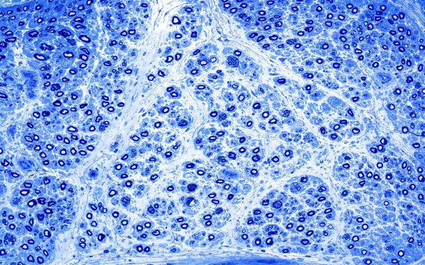 5A1 Axon loss, AIN nerve, (Case 5) Plastic 1