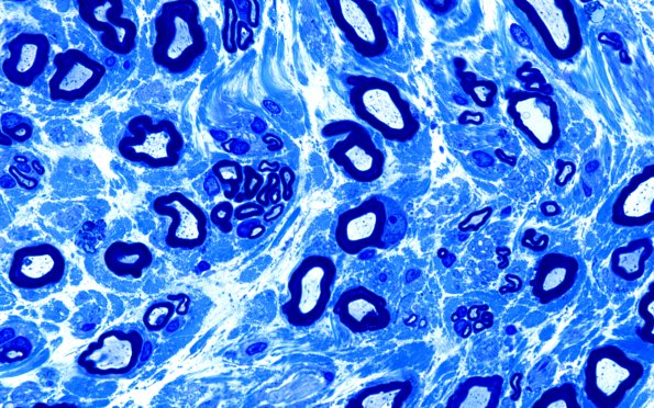 5A2 Axon loss, AIN nerve (Case 5) Plastic 2