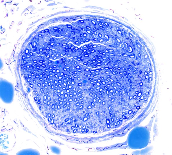 6A1 (Case 6) LABC Plastic 40X 2