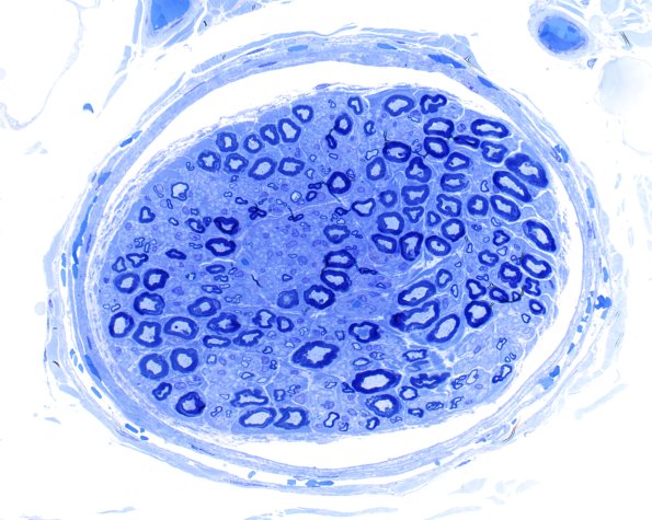 6A2 (Case 6) LABC Plastic 20X 1
