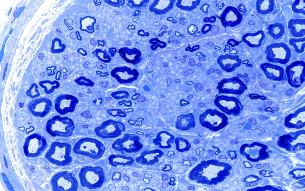 6A3 (Case 6) LABC Plastic 100X 1