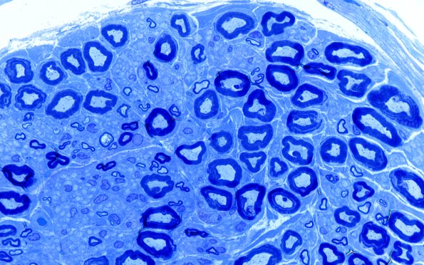 6A4 (Case 6) LABC Plastic 100X 3