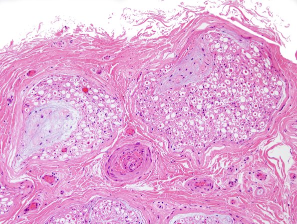 10A1 Renaut bodies (Case 10) H&E 3.jpg