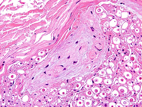 10A2 Renaut bodies (Case 10) H&E 7.jpg