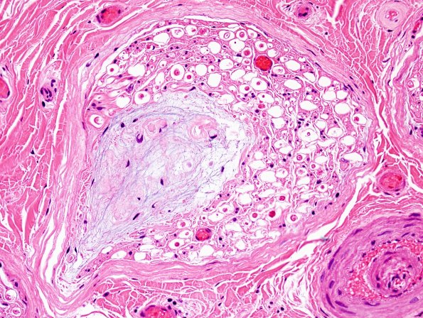 10A3 Renaut bodies (Case 10) H&E 4.jpg