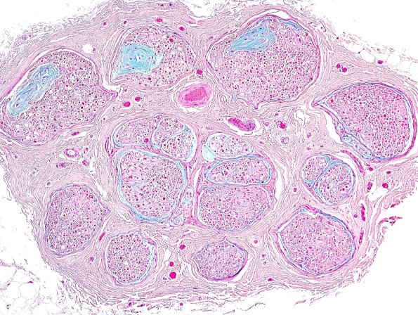 10B1 Renaut bodies (Case 10) Alcian Blue 2.jpg