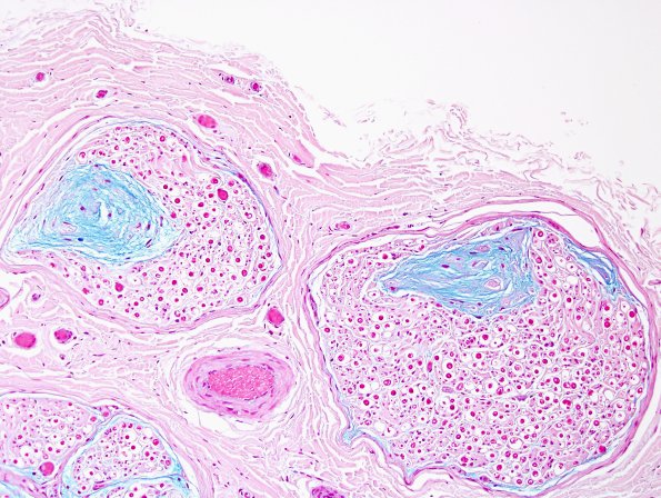 10B2 Renaut bodies (Case 10) Alcian Blue 3.jpg