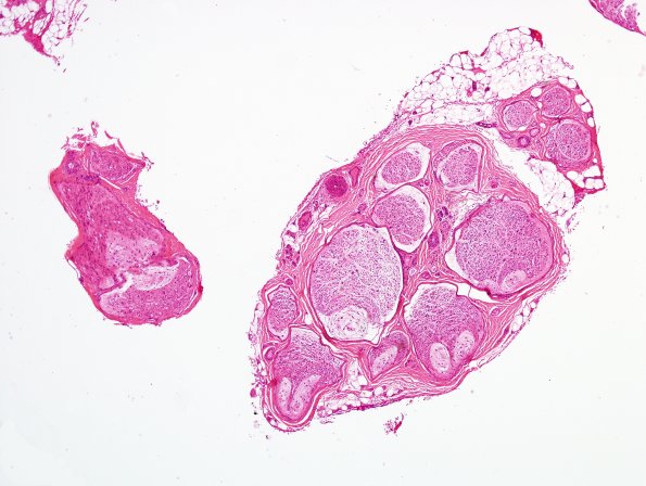 11A1 Renaut body (Case 11) H&E 2