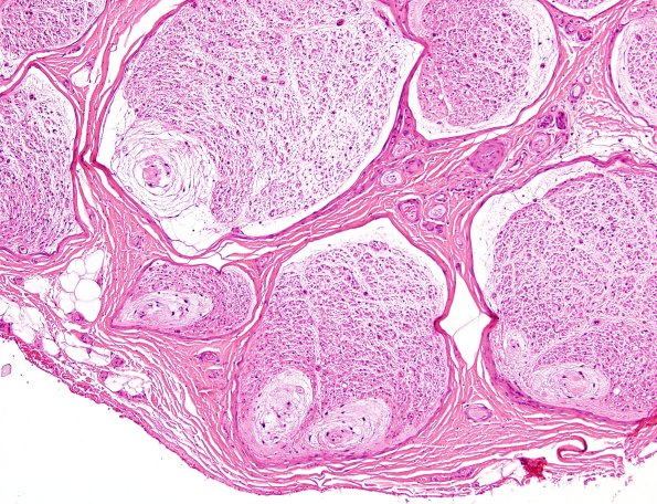 11A2 Renaut body (Case 11) H&E 4