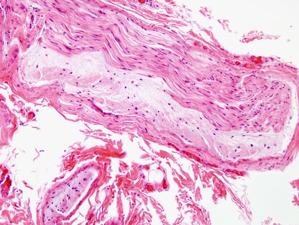 12B  Renaut body, longitudinal (Case 13) H&E 1