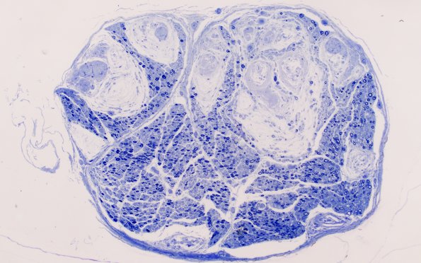 12E1 Renaut bodies (Case 16) Plastic 10X