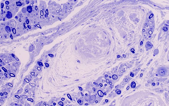 12E3 Renaut bodies (Case 16) Plastic 40X